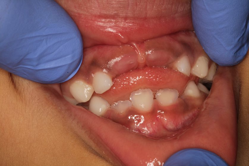Orthodontic Treatment in Deccan
