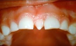 What Is a Mesiodense (Extra Tooth)? – Causes, Diagnosis & Treatment