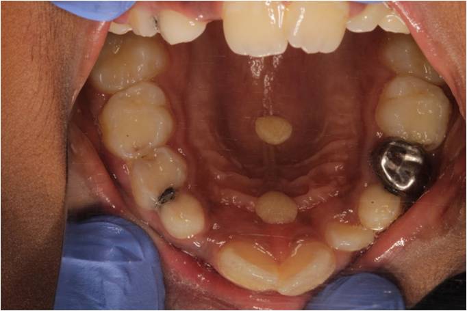 Dental Crowns