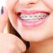 Orthodontics in Pune