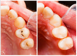 Children Catch Cavities