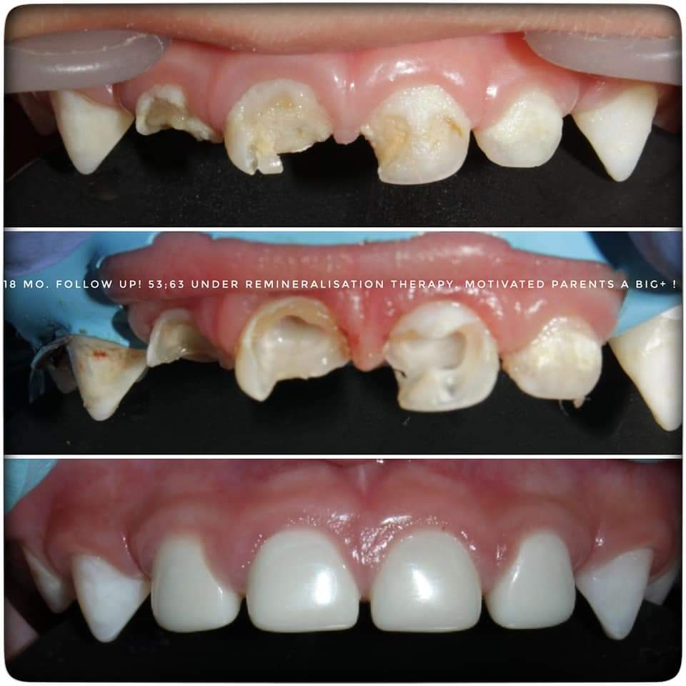 Orthodontics Treatment in Pune
