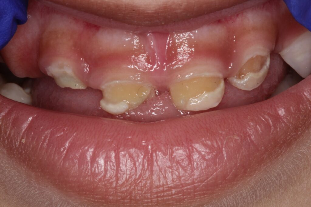 What is Early Childhood Caries? Causes & Treatment.