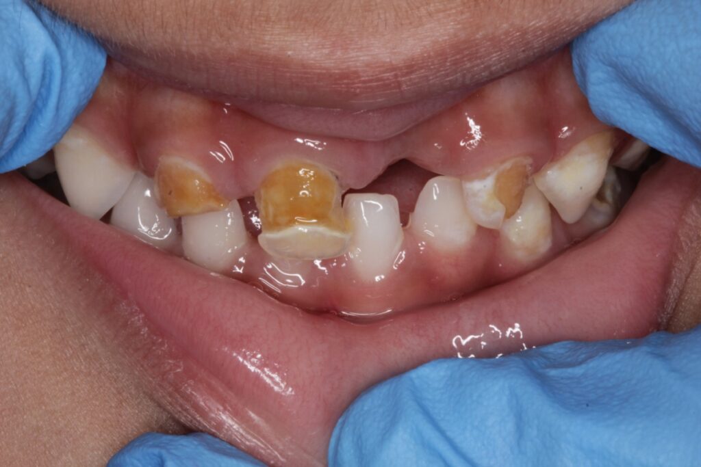 What is Early Childhood Caries? Causes & Treatment.