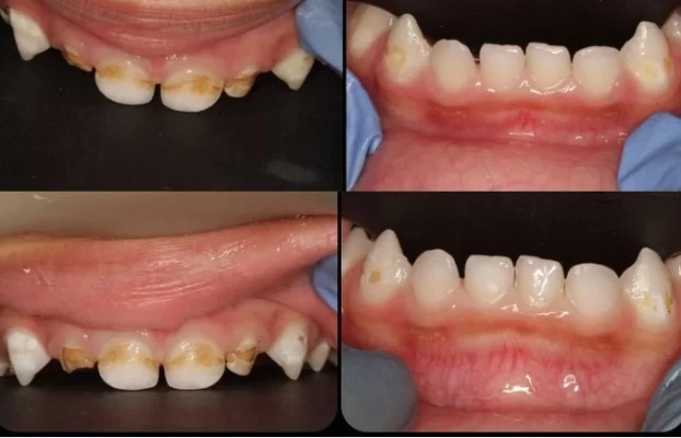 What is Early Childhood Caries? Causes & Treatment.