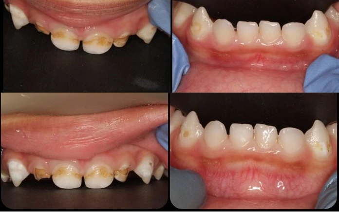 What is Early Childhood Caries? Causes & Treatment.