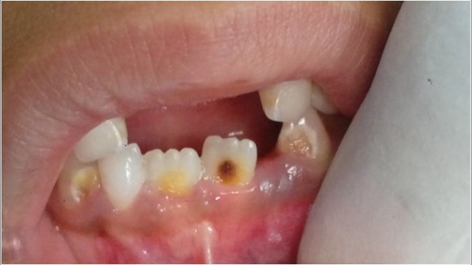 Dental enamel defects
