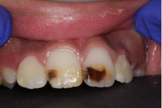 Dental enamel defects