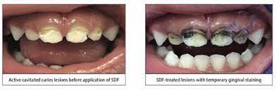 before and after child ECC TREATED