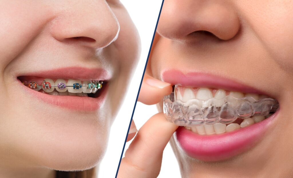 Invisalign in Pune Invisible Braces Cost in Pune Vanilla Smiles