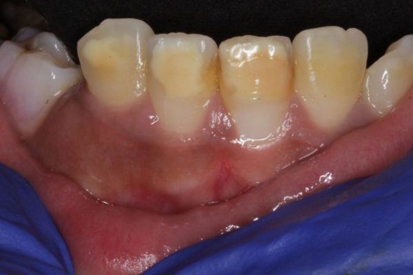 Molar-Incisor-Hypomineralization