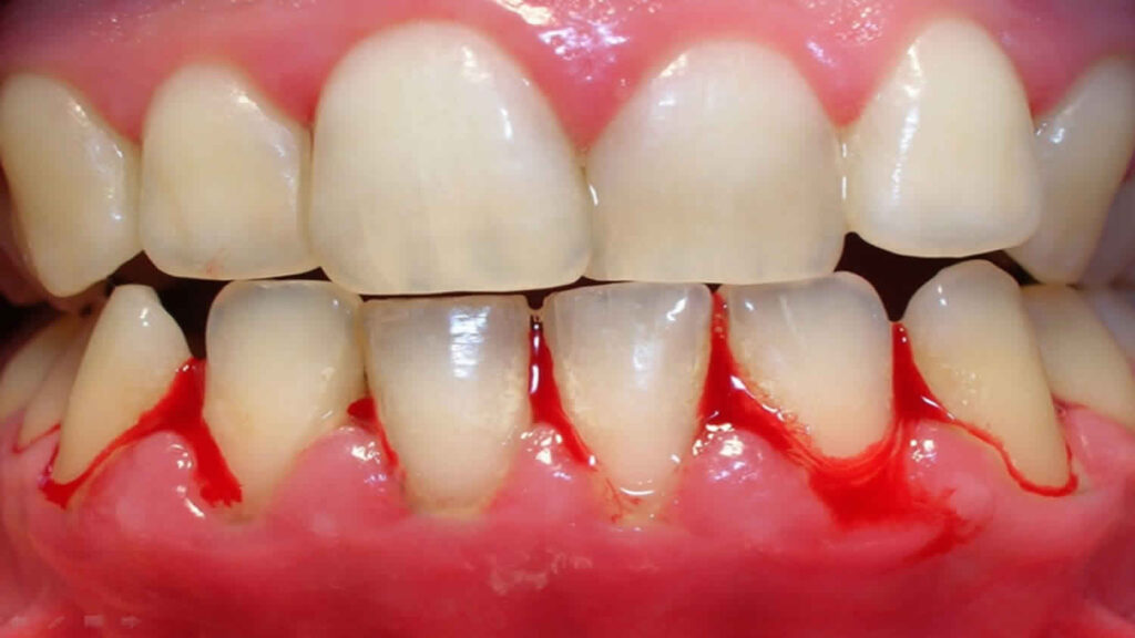 6 Potential Causes of Bleeding Gums Vanilla Smiles