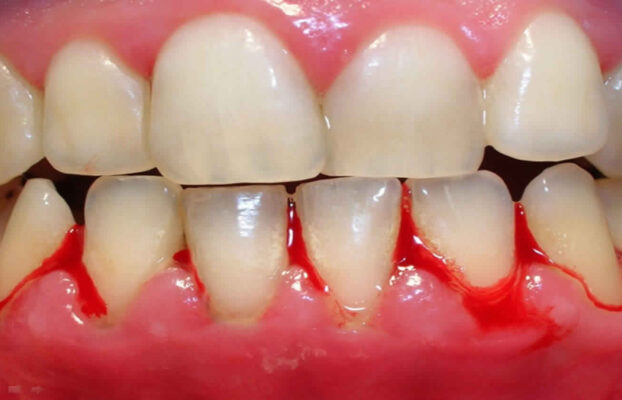 6 Potential Causes of Bleeding Gums