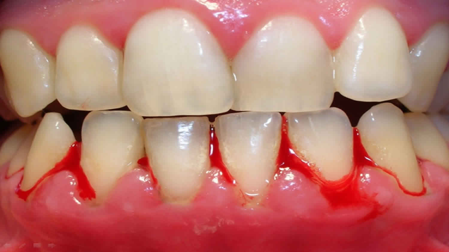 6 Potential Causes of Bleeding Gums