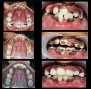 Orthodontist in Pune