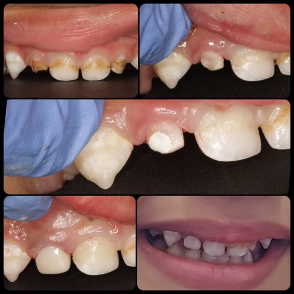 Dental Crown In Pune Dental Crown Near Me in Shivaji Nagar