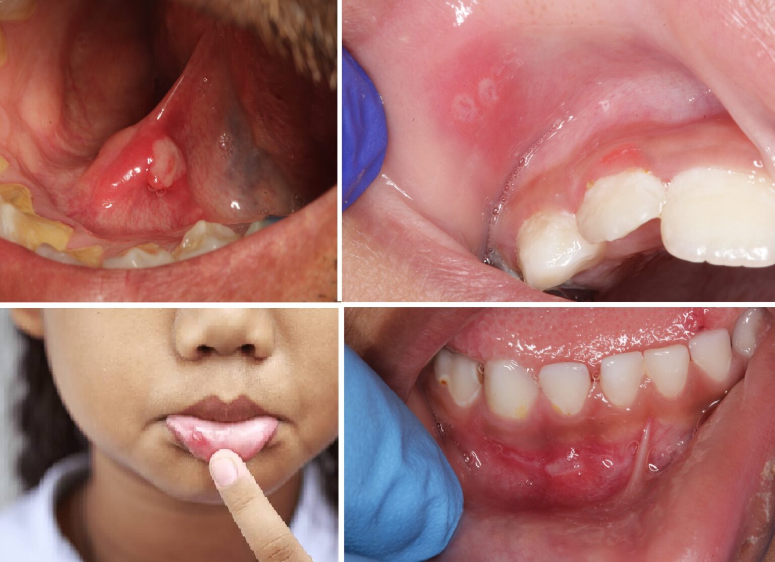 Oral Care for Babies with Canker Sores Vanilla Smiles Dental Clinic