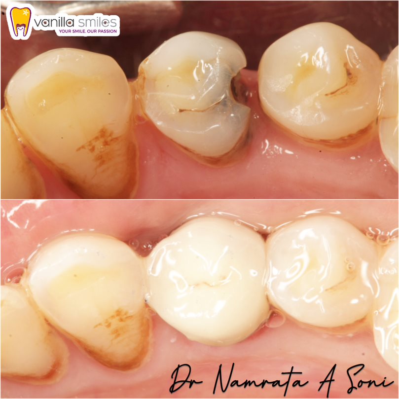 BEST DENTAL CROWN AND BRIDGE IN PUNE Dental Crown Near Me in Shivaji