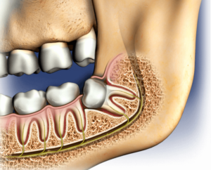 Wisdom Tooth Extraction In Pune