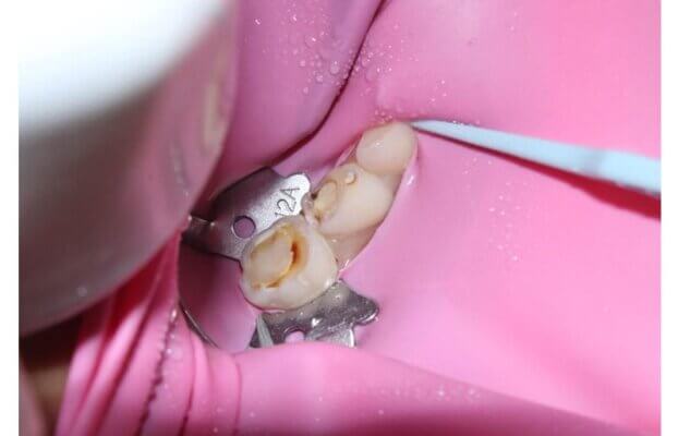 Maintaining Oral Health After a Root Canal: Tips and Advice from Pune’s Experts