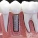 Dental Implants in pune