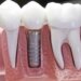 Dental Implants in pune