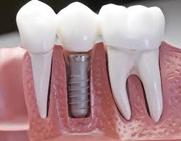 Overcoming Dental Anxiety: How Dental Implants Can Help in Pune