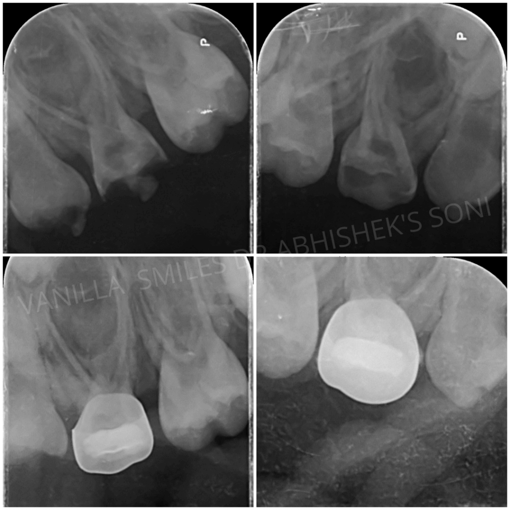 Dental X-Rays in Pune