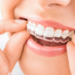 Invisalign Treatment at Vanilla Smiles Dental Clinic
