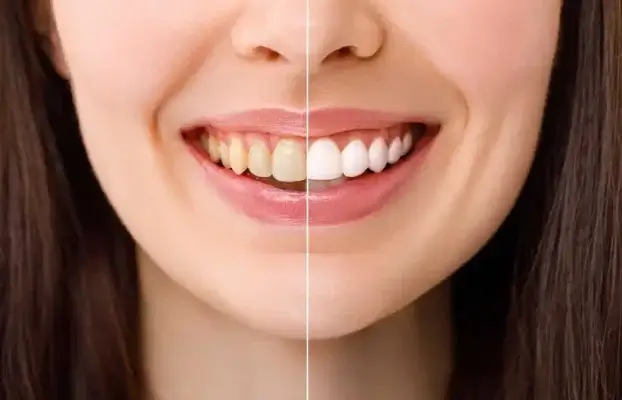 The Latest Trends in Teeth Whitening: Safe and Effective Solutions at Vanilla Smiles Dental Clinic in Shivaji Nagar, Pune