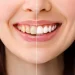 Teeth Whitening