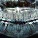 Dental X-Rays In Pune