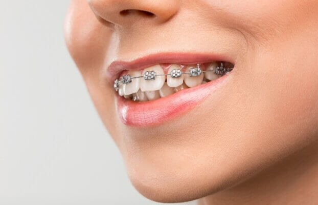 Understanding Braces Cost in Pune: A Complete Guide by Vanilla Smiles Dental Clinic, Shivaji Nagar