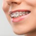 Braces Cost in Pune