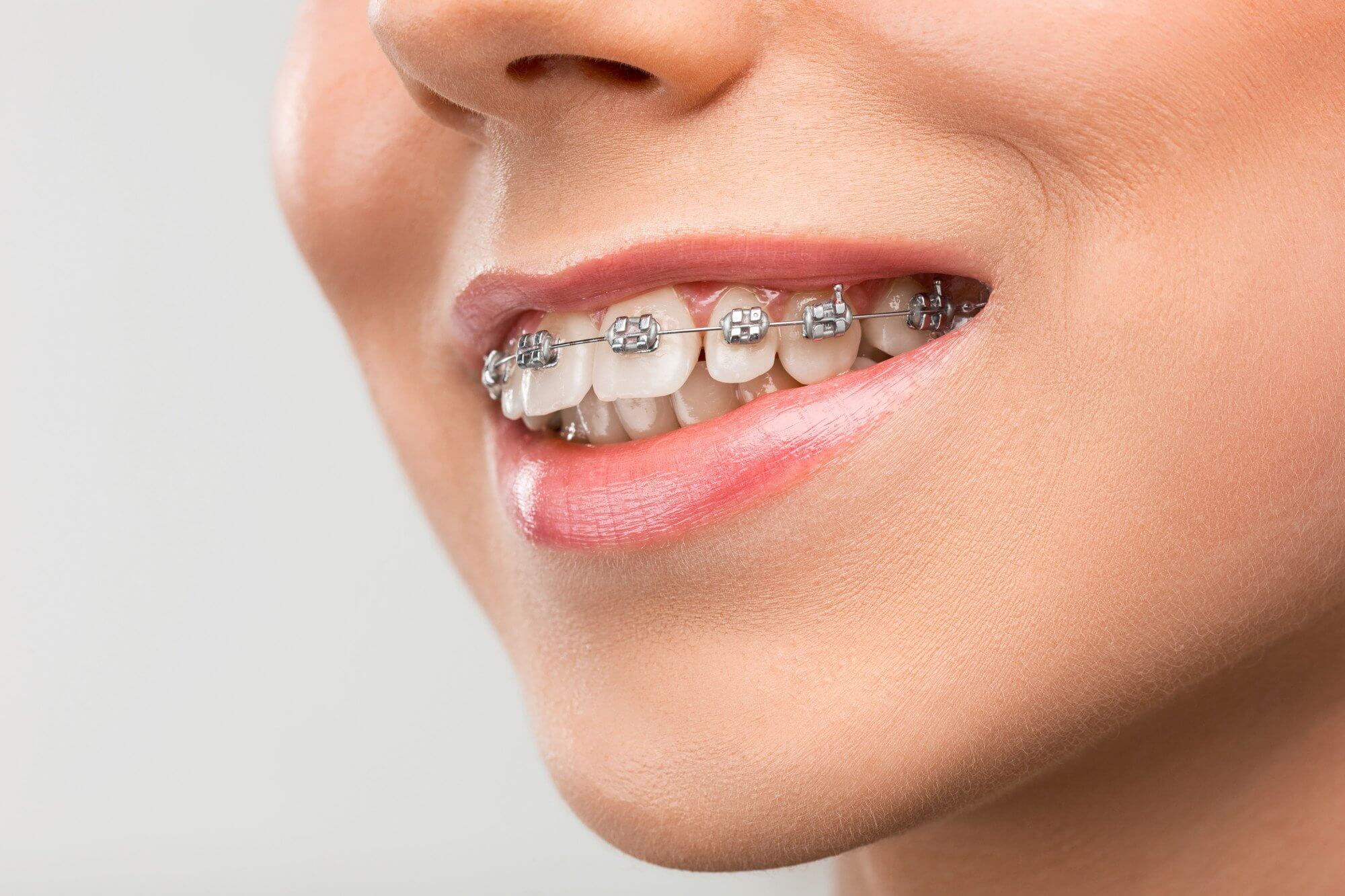 Understanding Braces Cost in Pune: A Complete Guide by Vanilla Smiles Dental Clinic, Shivaji Nagar