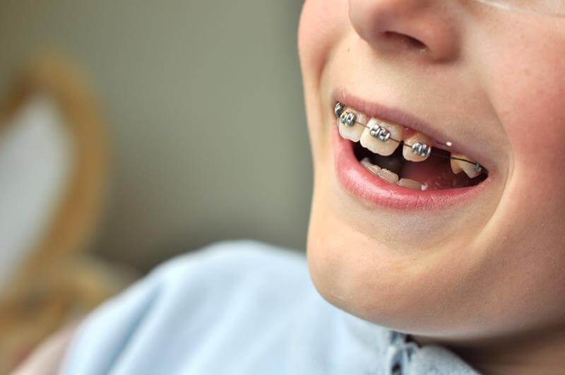 Dental Braces for Kids