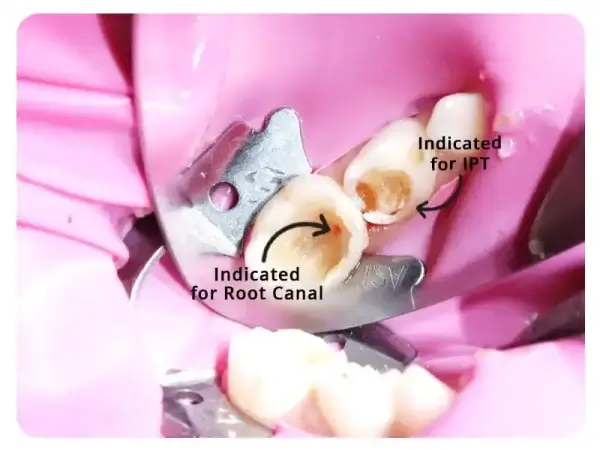 Baby Root Canal
