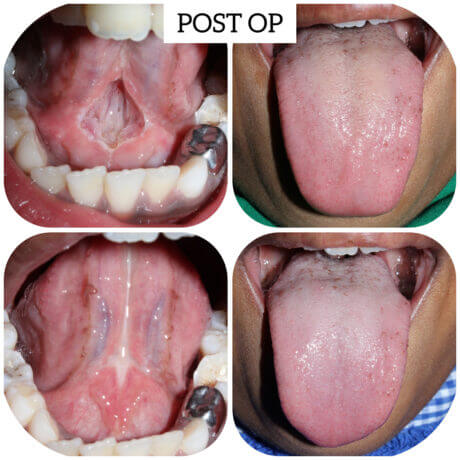 Why Choose Vanilla Smiles (Dr. Abhishek Soni) for Your Infant’s Tongue Tie Release?