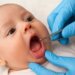 Infant’s Tongue Tie