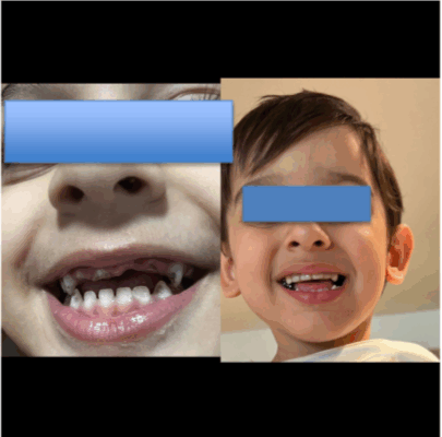 Full Mouth Rehabilitation under General Anaesthesia (GA) for Kids from Dubai – Now in Pune, India
