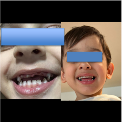 Full Mouth Rehabilitation under General Anaesthesia (GA) for Kids from Dubai – Now in Pune, India