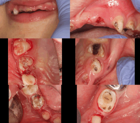 Does Dental Treatment Cost More Or Negligence ?