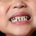 Kids Dental Crowns