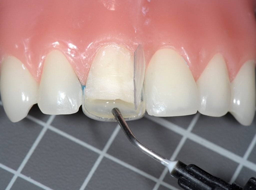 Resin Strip Crowns