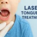 laser tongue tie treatment