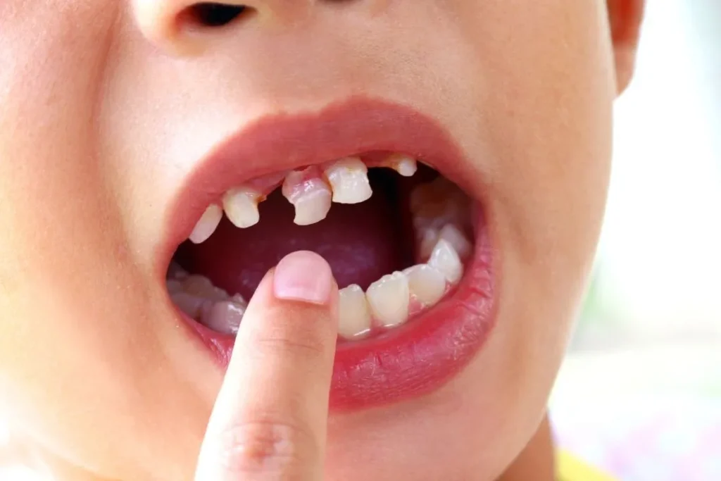 Tooth Eruption in Children