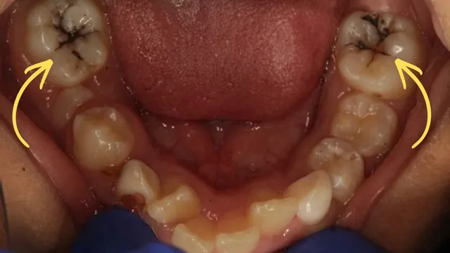 Silver Diamine Fluoride used as sealant on treated teeth in children
