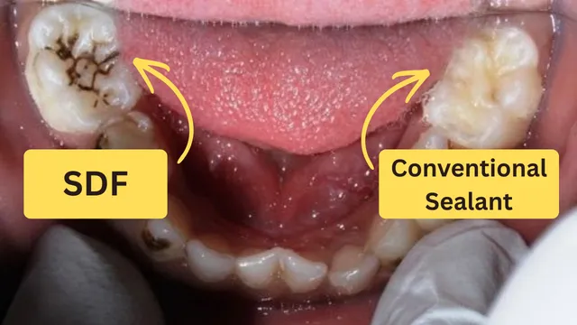 Comparison between SDF treatment and traditional dental sealant for kids
