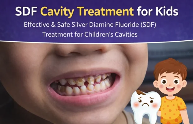 Silver Diamine Fluoride (SDF): A Modern Cavity Treatment for Kids