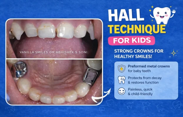 Understanding the Hall Technique: A Stress-Free Dental Treatment for Kids